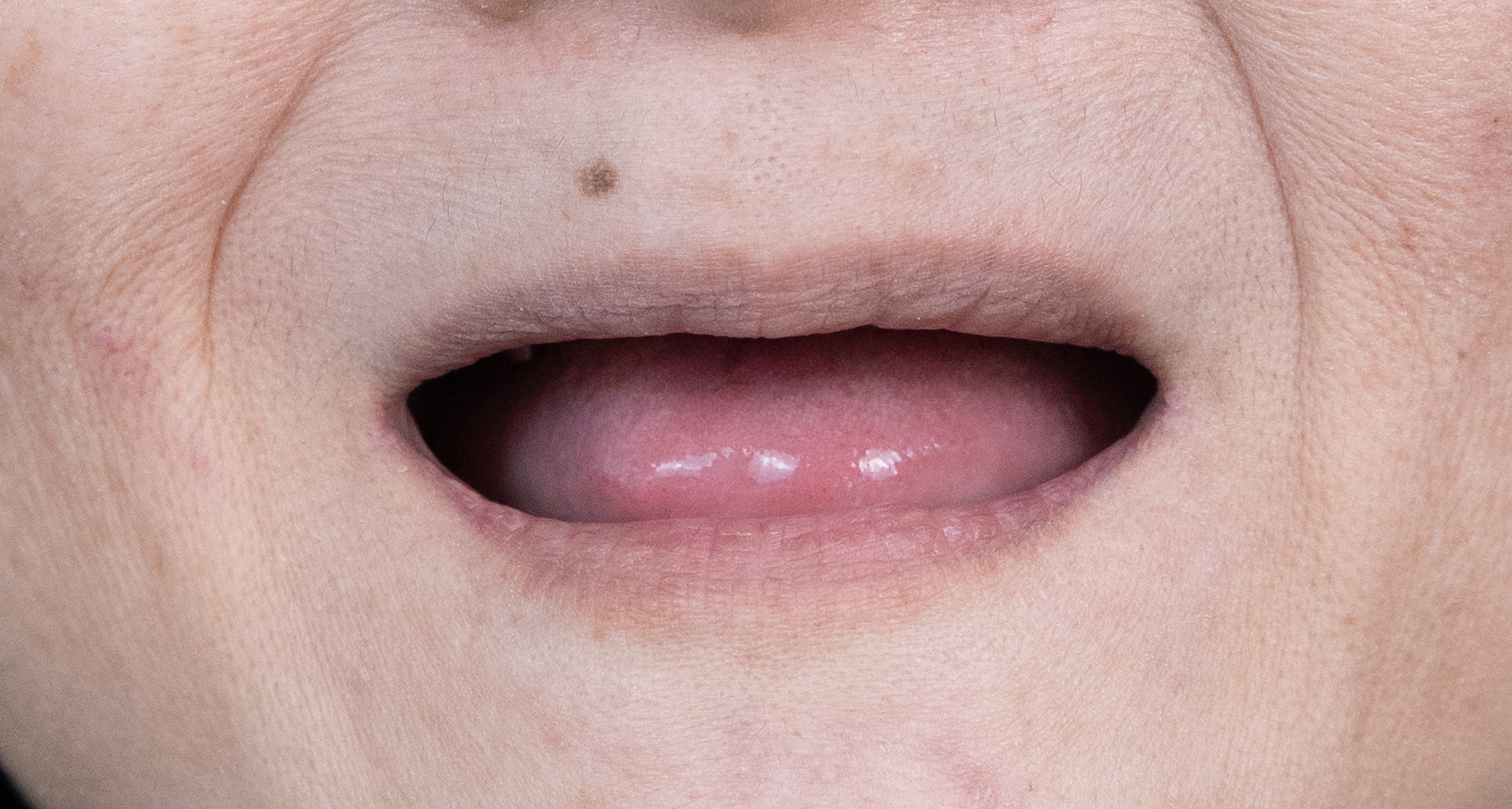 牙周病導致上顎多顆缺牙 → 上顎 All on 4 植牙重建-1