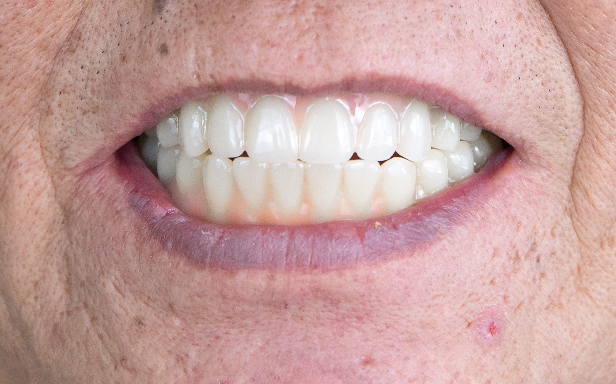 上下顎牙周病合併缺牙 → 上下顎 All on 4 全口重建-2