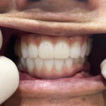 大範圍缺牙＋活動假牙配戴不適 → All on 4 全口植牙重建