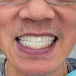 牙周病造成大範圍缺牙、清潔困難 → 上下顎 All on 4 重建