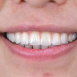 多年牙橋損壞、咬合不穩 → 上顎 All on 4 固定式重建